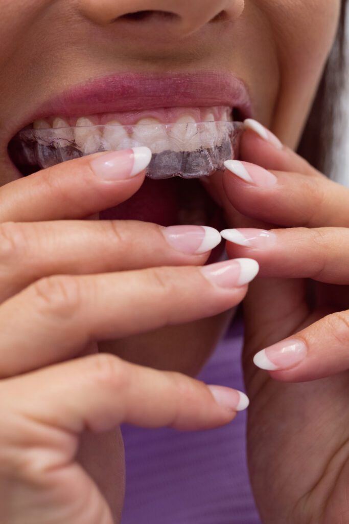 Close-up of female patient putting Invisalign tray